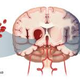 Illustration for article titled Obat Stroke Di Apotikem/em